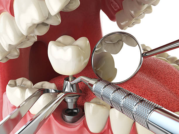 Best Emergency Root Canal Treatment in Denison, TX